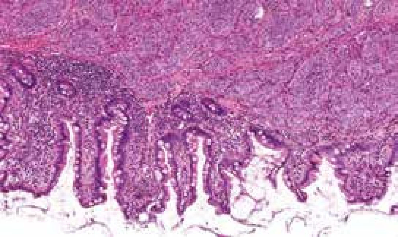 Histological section: NET infiltrating
submucosa of the small bowel wall,
HE staining, 200×