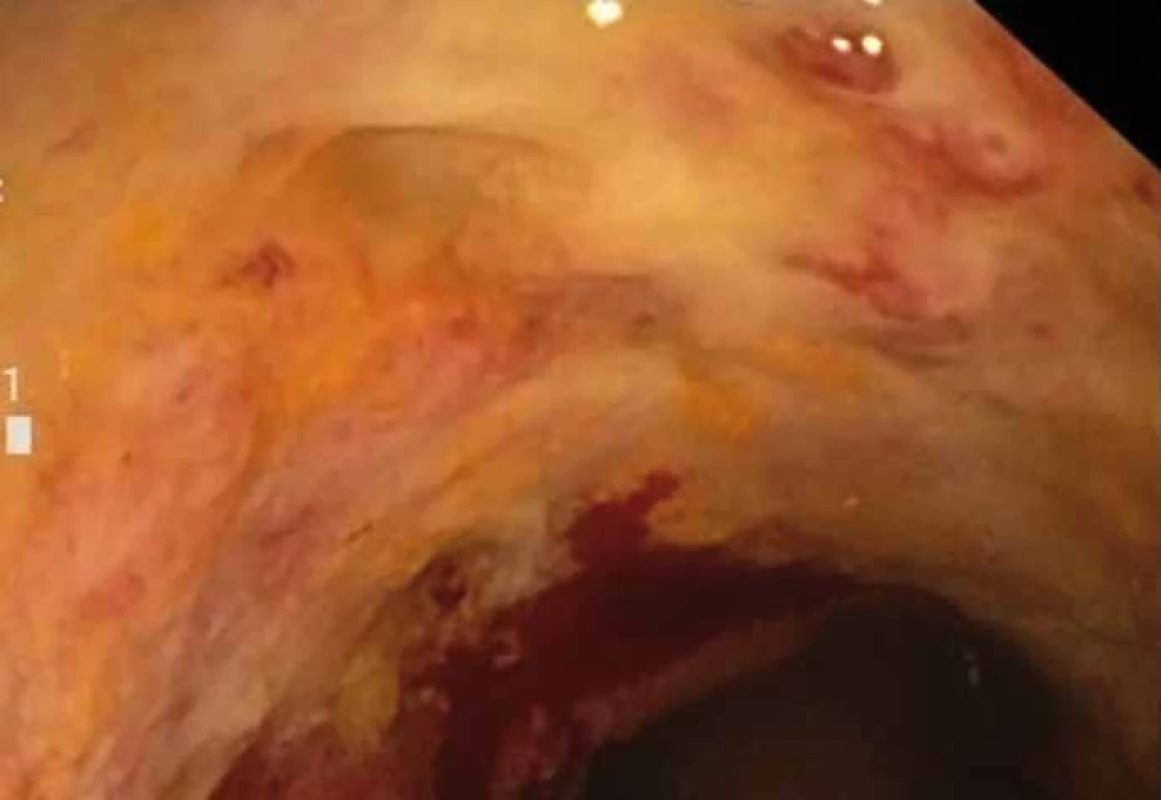 Stenóza střeva s regresí stenózy po dvou týdnech, s ulcerovanou spodinou.
Fig. 4. Stenosis of the bowel with stenosis regression after two weeks, with ulceration.