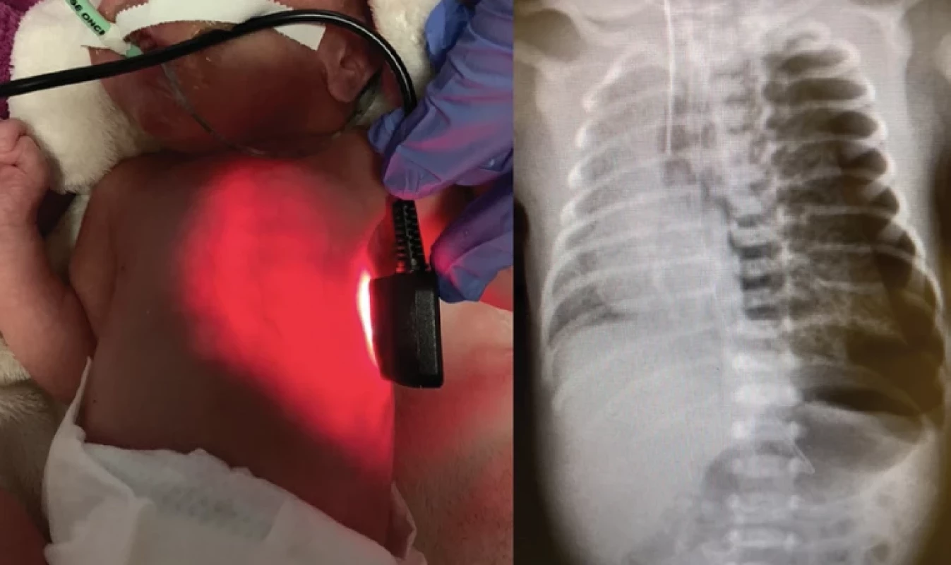 Tenzní  pneumotorax  (PNO) – pozitivní transiluminace  (prosvícení hrudníku  zdrojem silného světla – diafanoskopie)  levého hemitoraxu  s RTG korelátem  (projasnění bez  plicního parenchymu  s kolapsem levé plíce  a přesunem mediastina doprava)