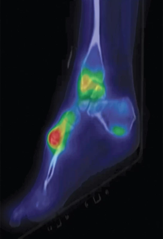Fúze SPECT/CT v pozdní fázi v sagitálním řezu – zvýšená akumulace RF nejvíce patrná v tarzometatarzálním skloubení 1. prstu s korelátem méně významných degenerativních změn, mírně vyšší akumulace RF rovněž i v místě drobné exostózy kosti patní.