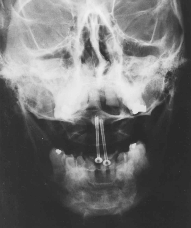 RTG obraz kompresní osteosyntézy kanalizovanými šrouby v axiální ose
Fig. 4. X-ray axial view of the compression osteosynthesis with canalised screws