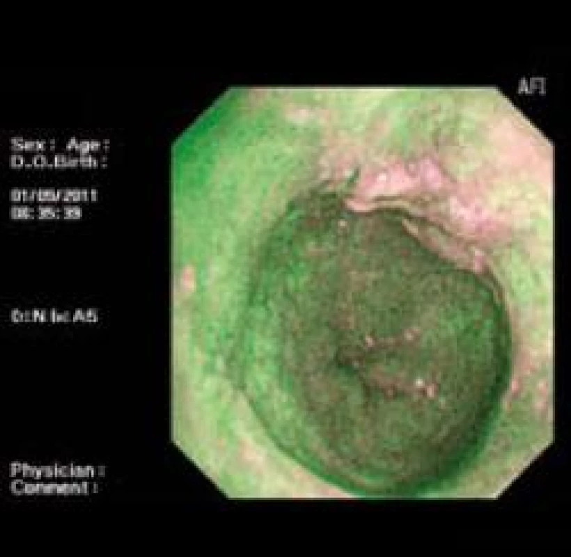 AFI zobrazení intramukózního karcinomu.
Fig. 6. AFI of intramucosal carcinoma.