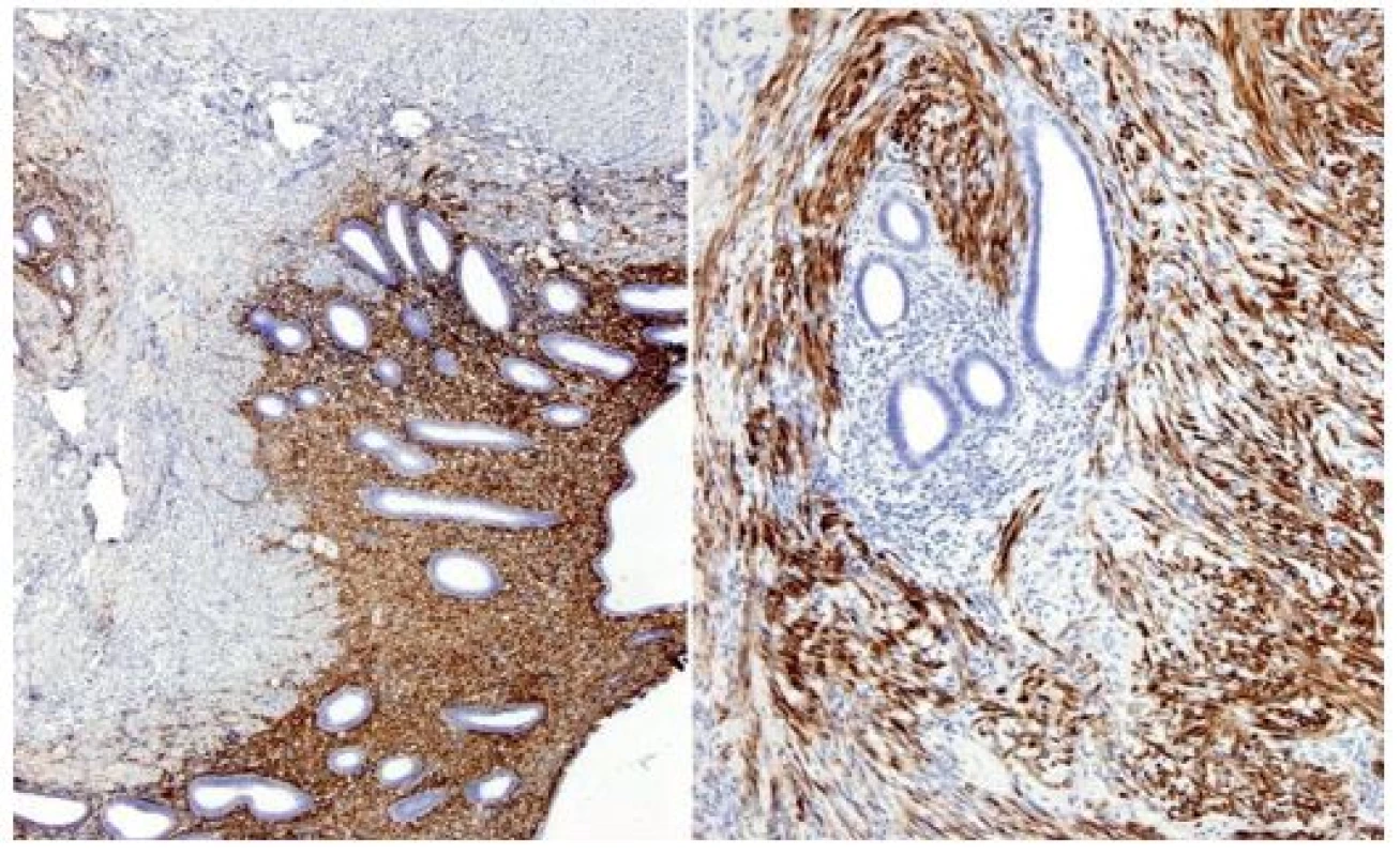Histopatologický obraz endometriózy (imunohistochemie)
Fig. 4: Histopathological finding of endometriosis (immunohistochemistry)