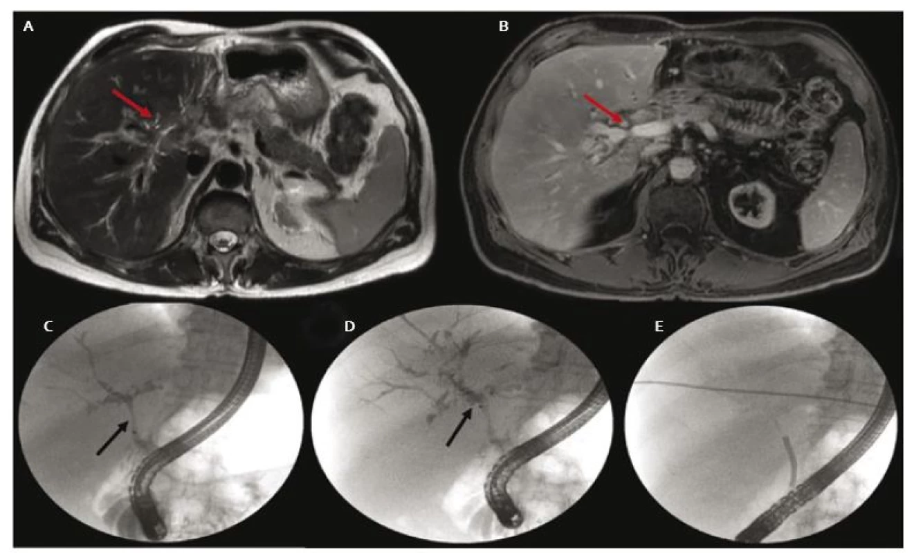 A. MRCP obraz tumoróznej lézie oblasti junkcie hepatikov (šipka), B. stenóza duktus hepatikus communis (šípka), C. stenóza distálneho choledochu (šípka), D. defekty v náplni v oblasti junkcie (šípka), dilatované intrahepatálne žlčovody pravého hepatiku, E. SpyScope<sup>®</sup> v oblasti junkcie počas cholangioskopie.
Fig. 4. A. MRCP image of a tumorous lesion in the hilar region (arrow), B. common hepatic duct stenosis (arrow), C. distal stenosis of the choledochus (arrow), D. filling defects at the hepatic junction (arrow), intrahepatic bile ducts dilatation in the right hepatic duct, E. SpyScope<sup>®</sup> placement in the hepatic junction during cholangioscopy.
