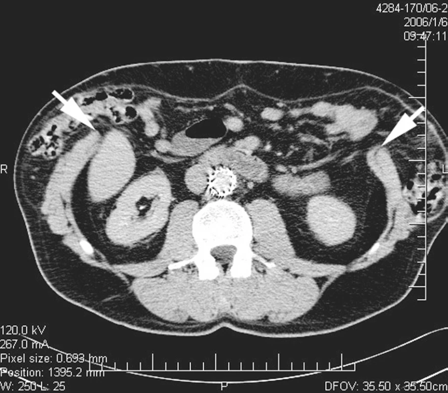 Nativní CT břicha v úrovni L3, zobrazující defekt břišní stěny. Šipky označují okraje svalové břišní stěny.
Pic. 5. Native abdominal CT scan at the level of L3 showing the defect of abdominal wall. Arrows mark borders of muscular abdominal wall.