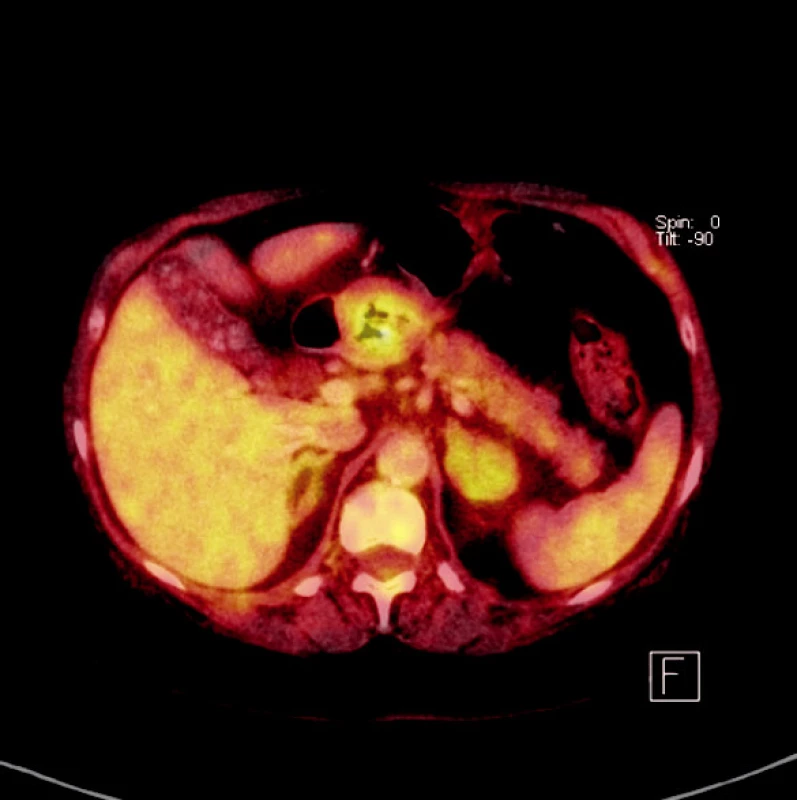 PET-CT: tumor žaludku
Fig. 1. PET-CT: gastric tumor