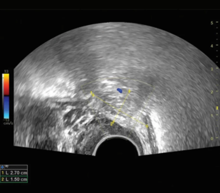 Ultrasound picture of the mesorectum between rectum and vagina. Obr. 7. Ultrazvukové zobrazení pooperačního nálezu kalipery nastaveny na mesorektum mezi stěnou rekta a pochvy.