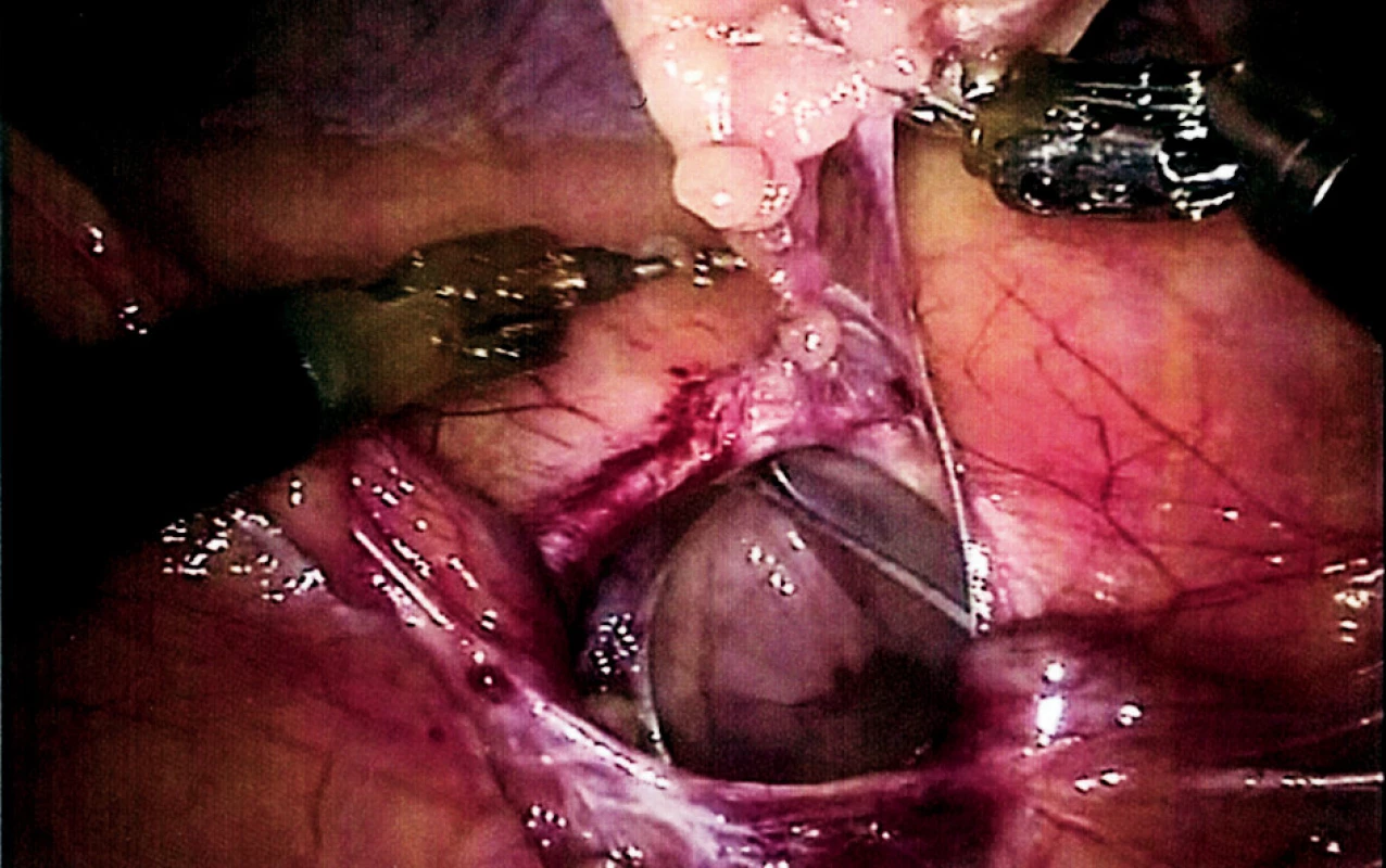 Robotické uvolnění omenta a obnažení okraje kýlní branky
Fig. 4. Robotic release of the omentum and exposure of the hernia orifice