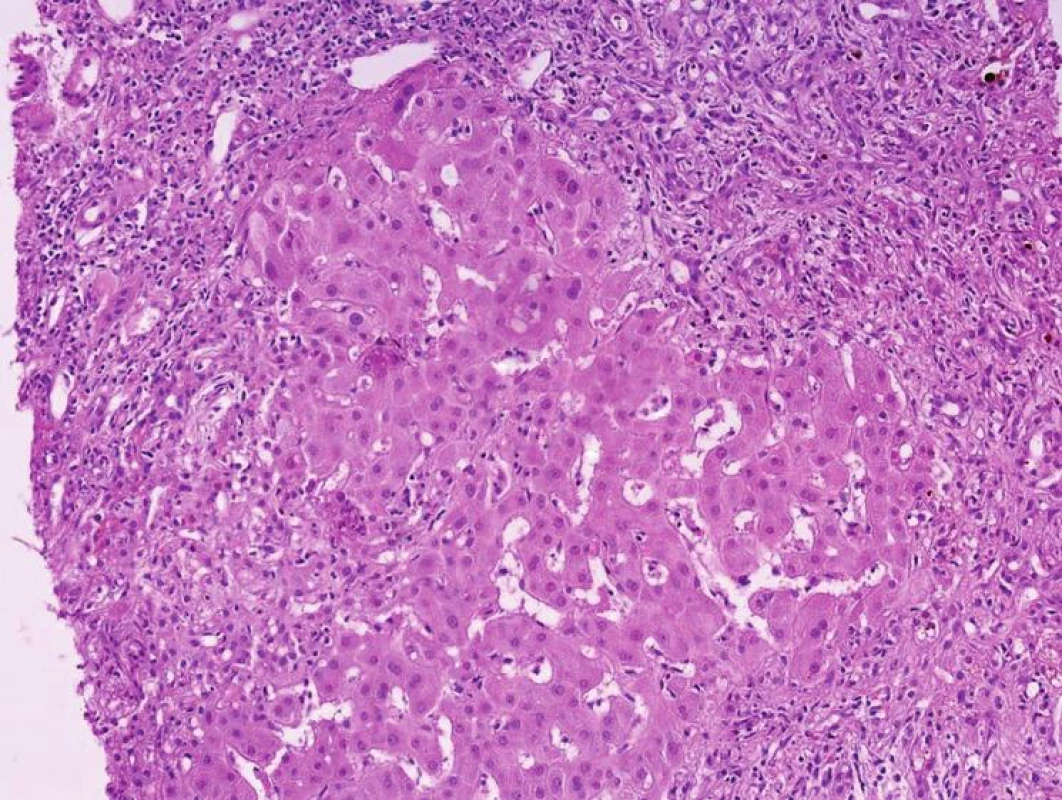 Jaterní biopsie při trombóze hepatické arterie. Morfologie odpovídá poruše žlučové drenáže 
s nápadnou chronickou cholestázou s cholestatickými rozetami.