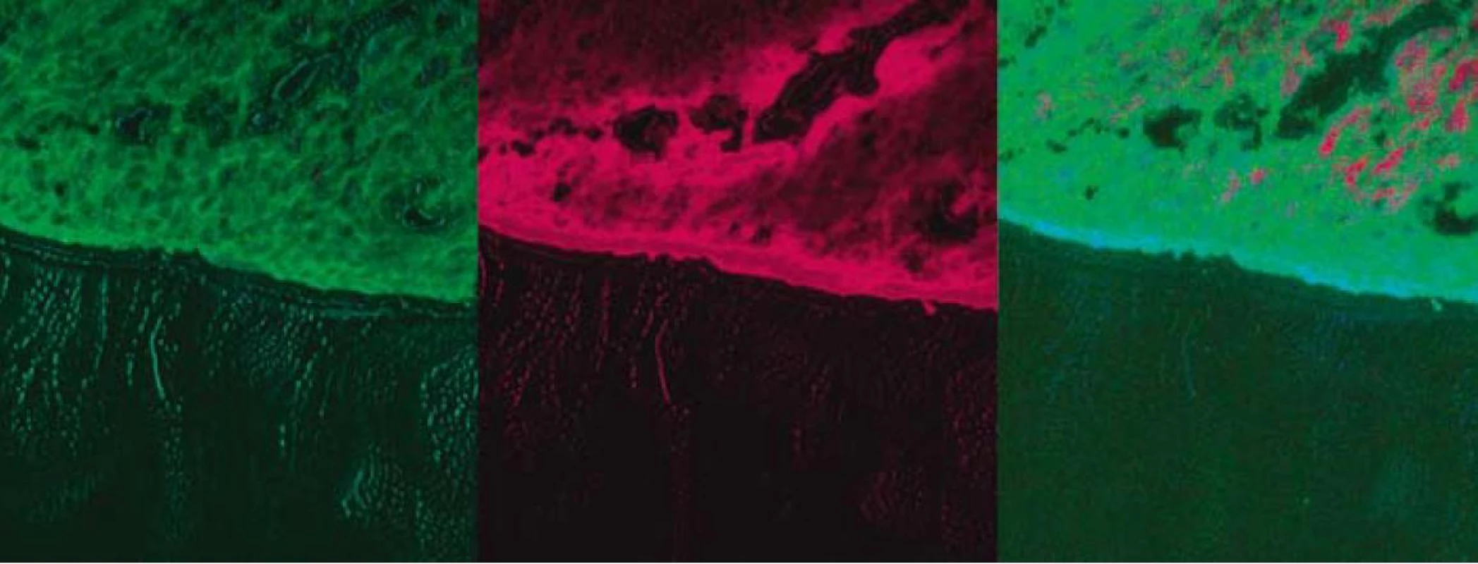 Fluorescenčná štúdia s použitím fotosenzitizátora ALA – tubulárny adenóm rekta s LGD.
Fig. 2. Fluorescence study with photosensitizer ALA – tubular rectal adenoma with LGD.