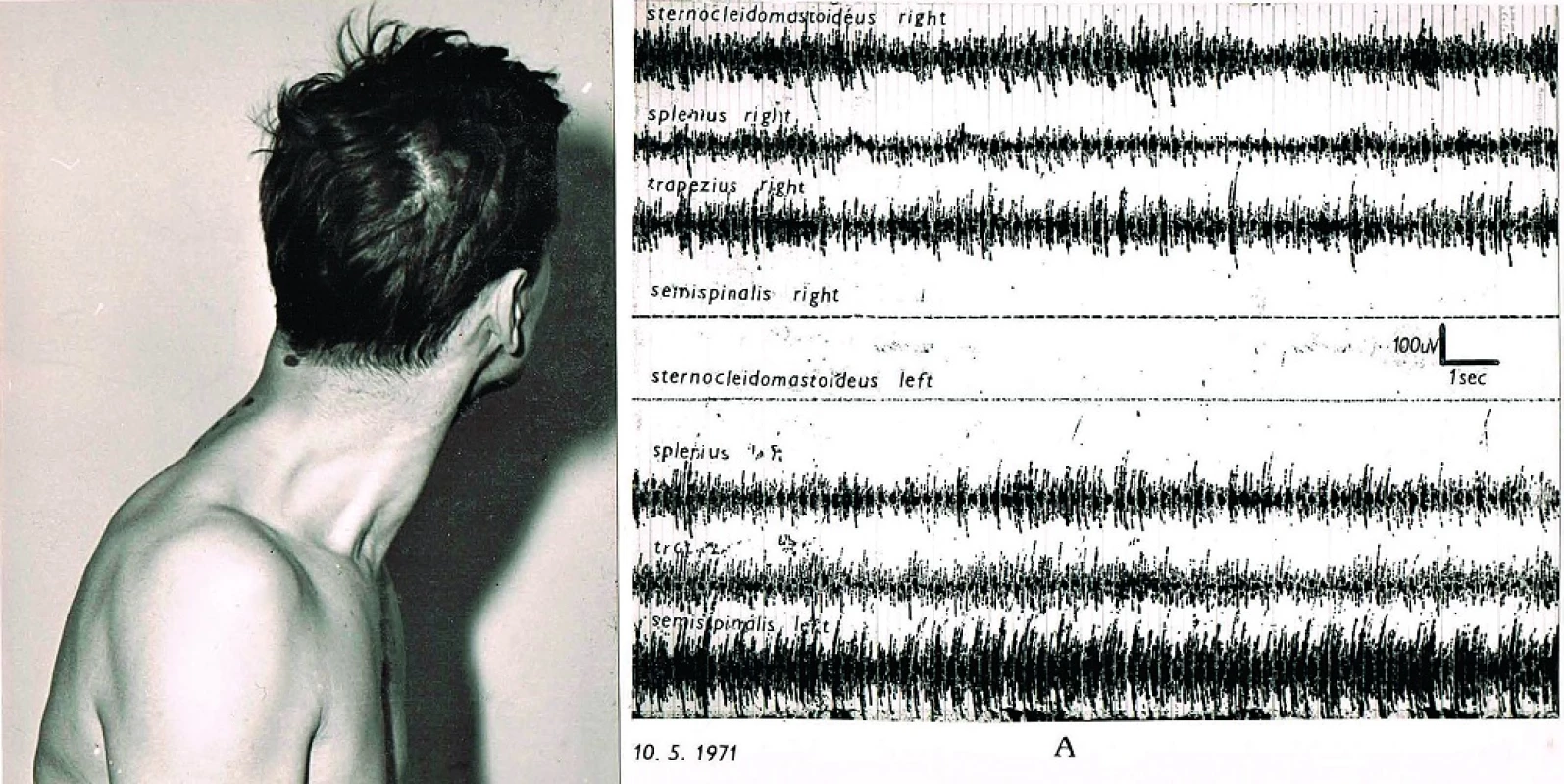 Cervikální dystonie rotační doleva těžkého stupně. Klidový záznam. Převažuje aktivita m. semispinalis vlevo (8. řádek), inaktivní jsou m. semispinalis vpravo a kývač vlevo (4. a 5. řádek).
