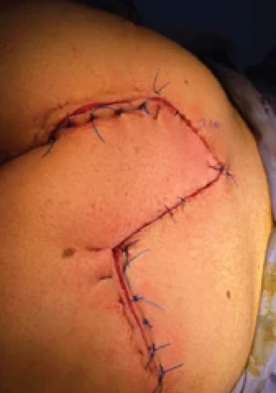 Final result of surgery.