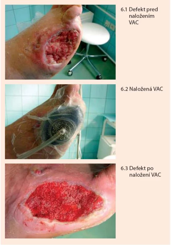 Liečba defektu pomocou podtlaku (Vacuum Assisted Closure Therapy)