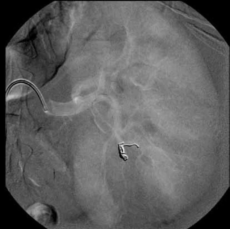 DSA po embolizaci
Fig. 2. DSA after embolisation