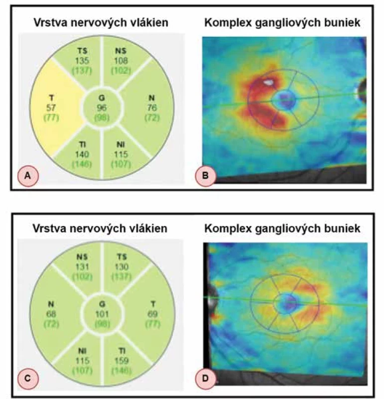 Výsledky vstupných vyšetrení u pacienta z kazuistiky č. 2. Zľava hrúbka nervových vlákien (A, C) a komplex gangliových buniek (B, D). Horný riadok znázorňuje nálezy na pravom oku (A, B), dolný riadok nálezy na ľavom oku (C, D)
