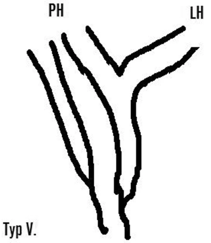 Bismuthova klasifikace striktur žlučových cest
Fig. 2. Bismuth classification of bile duct strictures