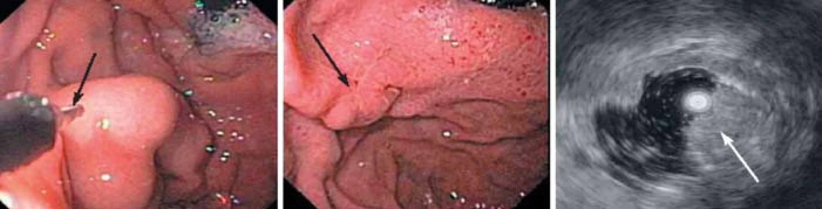 EVO. A – veľký varix pred podaním injekcie, B – 9 mesiacov po EVO, v mieste obliterácie jazva, C – EUS ukazuje obliteráciu lúmenu varixu po EVO [23].
Fig. 9. EVO. A – large varix before injection, B – 9 months after EVO, the scar at the site of obliteration, C – EUS finding – luminal obliteration of varices after EVO [23].