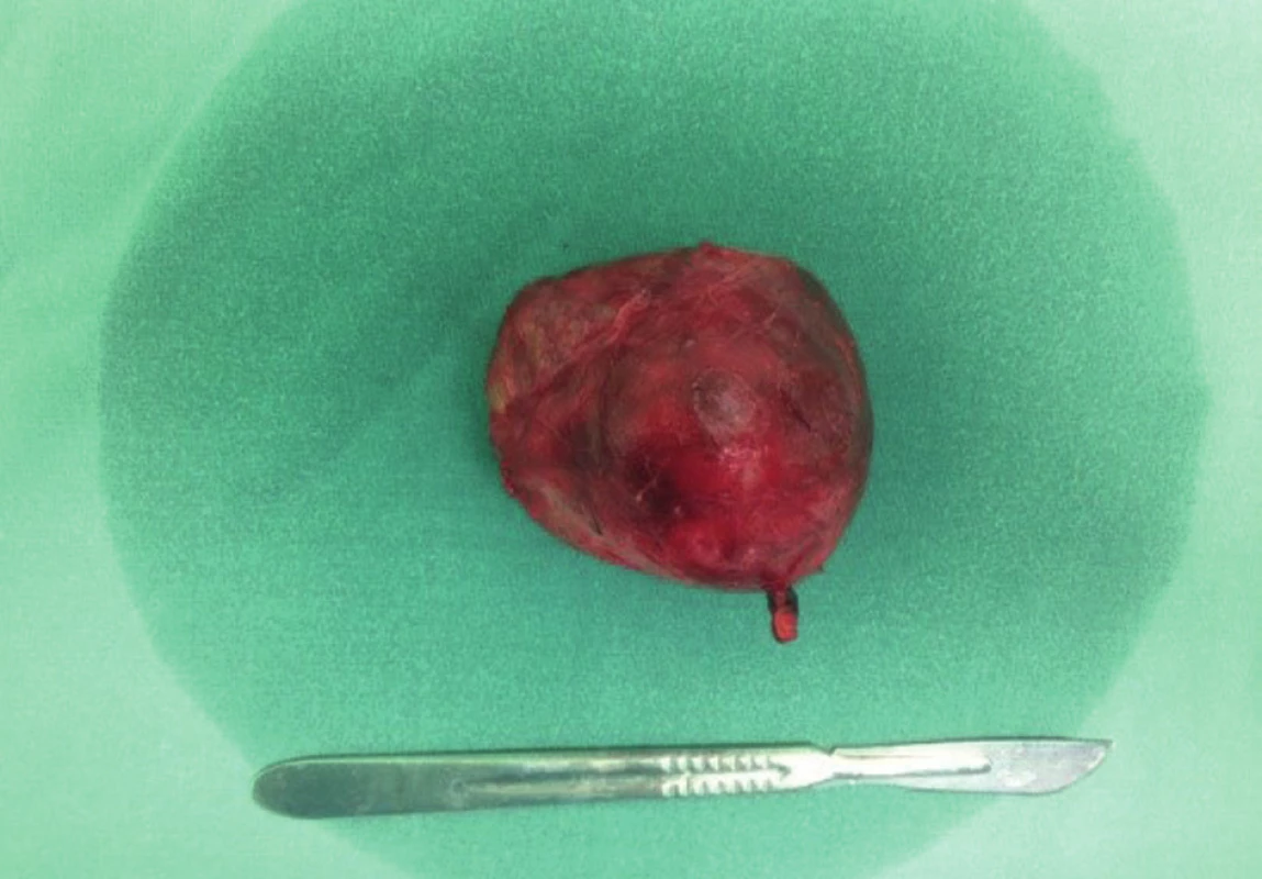 Resekát schwannomu
Fig. 3: Resected schwannoma