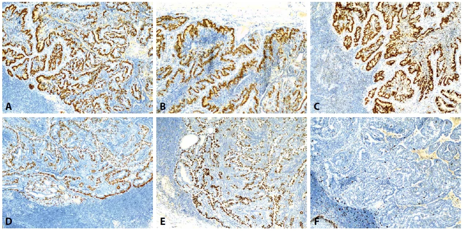 Souhrn imunohistochemického vyšetření léze v lymfatické uzlině prvního případu: estrogenový receptor (ER), pozitivní (A, zvětšeno 100x), progesteronový receptor (PR), pozitivní (B, zvětšeno 100x), GATA3, pozitivní (C, zvětšeno 100x), p40 a p63 jako průkaz zachovalé vrstvy myoepitelií (D, resp. E, zvětšeno 100x), proliferační aktivita/exprese Ki67 dosahovala v tomto případě 1-2 % (F, zvětšeno 100x).