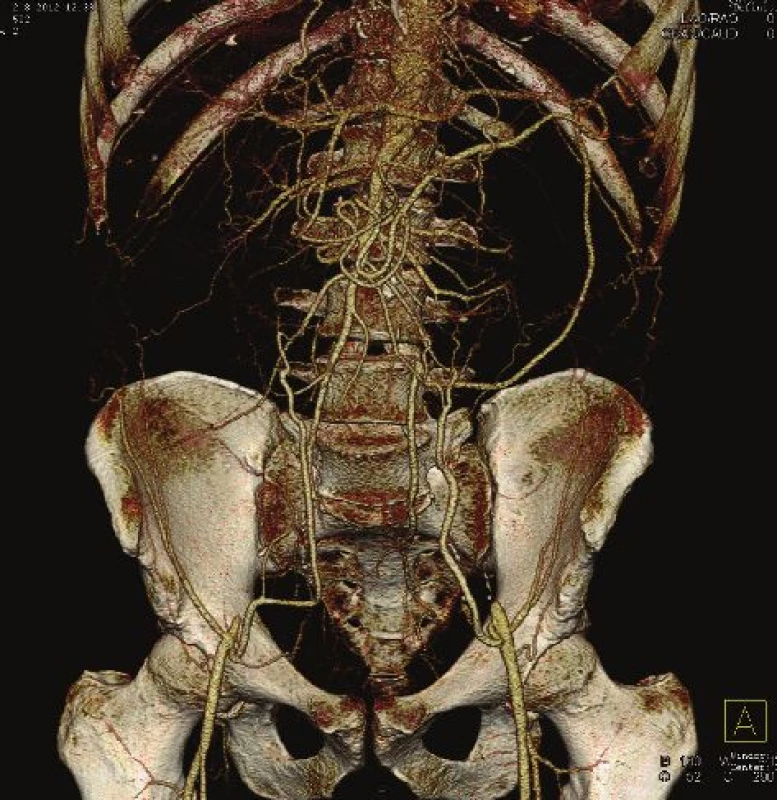 Uzávěr subrenální aorty – CTAG
Fig. 1: Occlusion of the subrenal aorta – CTAG