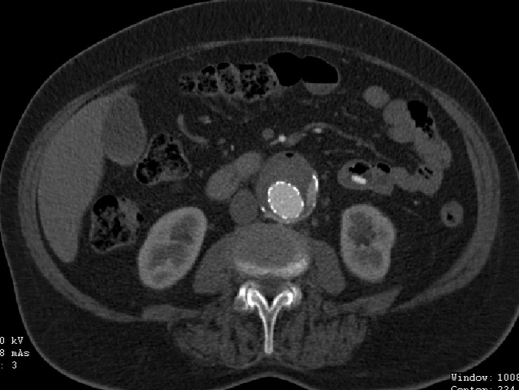 CTA obraz endoleaku II. typu a možná i III. typu
Fig. 13: CTA image of type II endoleak and possibly type III. endoleak