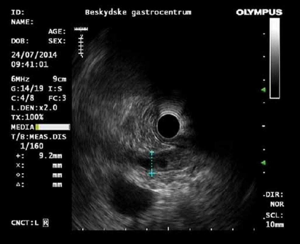 EUS: dilatace d. choledochus a jeho vyplnění hypoechogenními hmotami nevrhající akustický stín.
Fig. 5. EUS: dilatation of the common bile duct, intraductal solid masses with no distal acoustic shadowing.