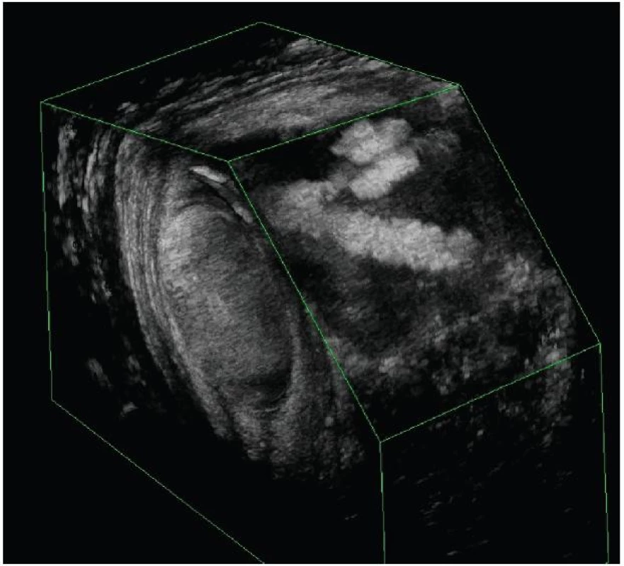 3D endosonografický obraz dvouchobotové píštěle tvaru „V“
Fig. 3: 3D endosonography imaging of double-sinus V-shaped fistula