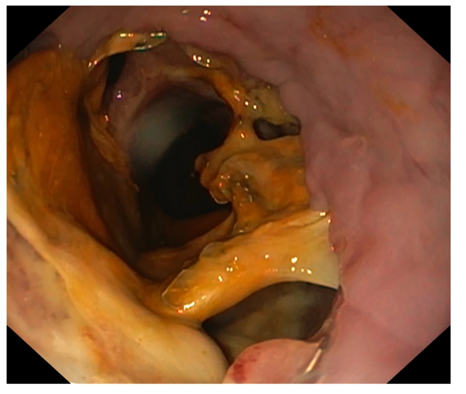 Endoskopický obraz dehiscence 70 % obvodu anastomózy
s okrskovou nekrózou, léčba stentem selhala<br>
Fig. 3: Endoscopic image of dehiscence of 70% of the circumference
of the anastomosis with focal necrosis; stent
treatment failed