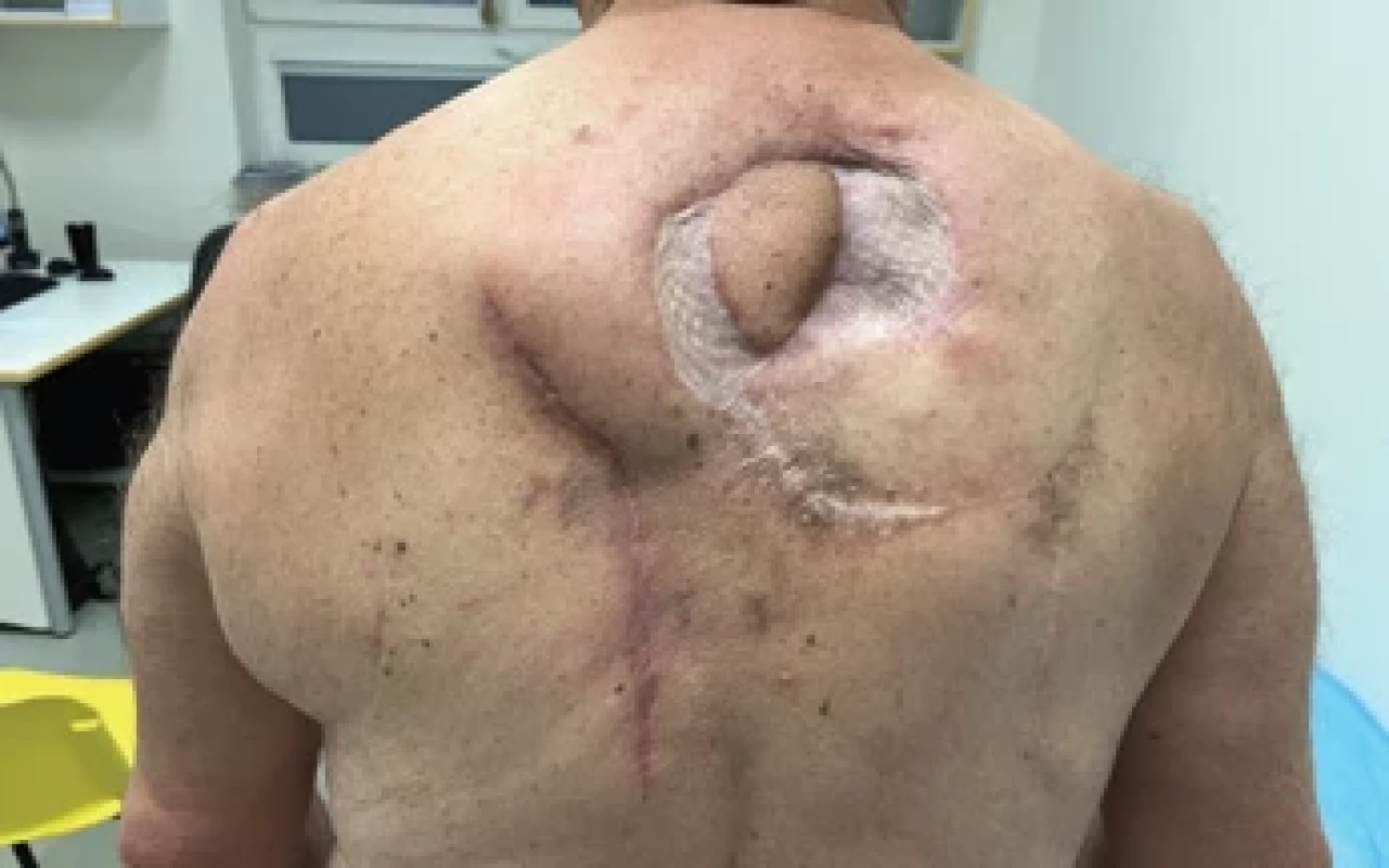 Healed flap and donor site at three months follow-up.