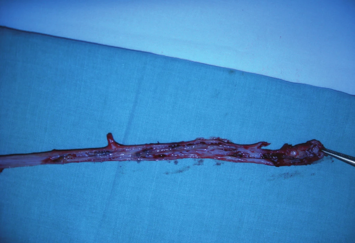 Reziduální trombus v luminu proximální části kmene VSM – příčina sukcesivní PE
Fig. 6: Residual thrombus in the upper part of GSV – the cause of pulmonary embolism