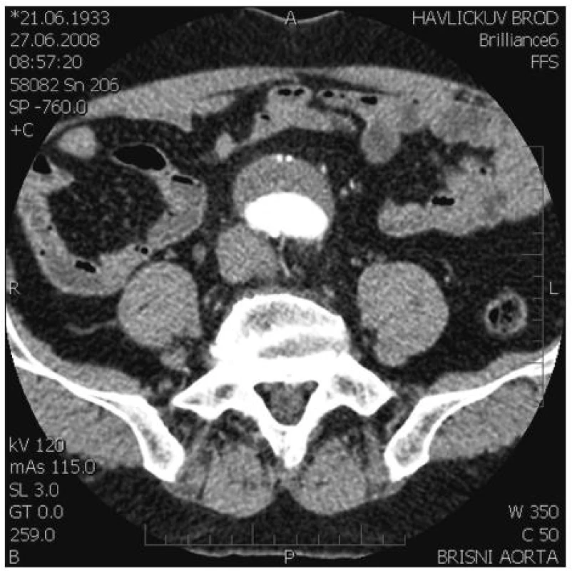 Verifikace průchodných větví na předoperační CT AG: na zadním obvodu a. sacralis mediana
Fig. 1. Verification of patent branches on preoperative CT AG: posterior circumference of a. sacralis mediana
