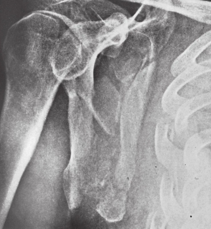 Kominutivní zlomenina těla lopatky u polytraumatizovaného pacienta s dobře patrnou sériovou zlomeninou žeber
Fig. 2: Comminuted fracture of scapular body in polytrauma patient with evident serial rib fractures