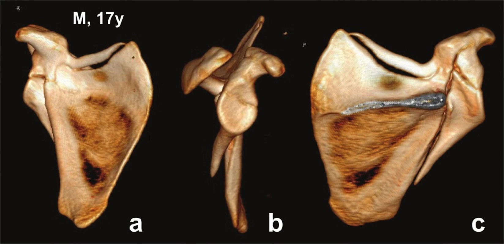 Glenoid fossa fractures (two fragments) with separation through the coracoid process − CT 3D reconstructions (Pt − 7)