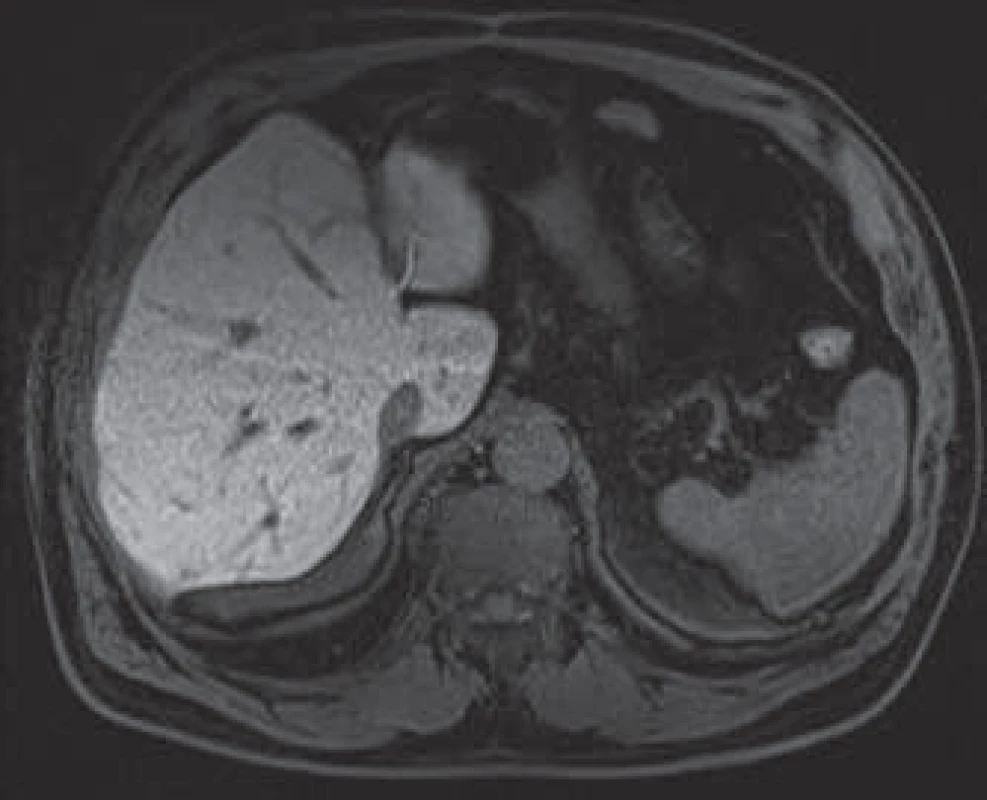Stav po resekci ložiska, bez známek recidivy onemocnění.
Fig. 5. After resection of the lesion, no sign of relapse.