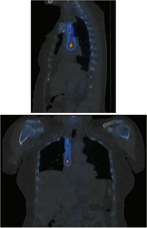 Fúzovaný SPECT/CT snímek hrudníku v koronární rovině (dole) a sagitální rovině (nahoře) prokazující korelaci lineární akumulace s průběhem centrálního katétru.