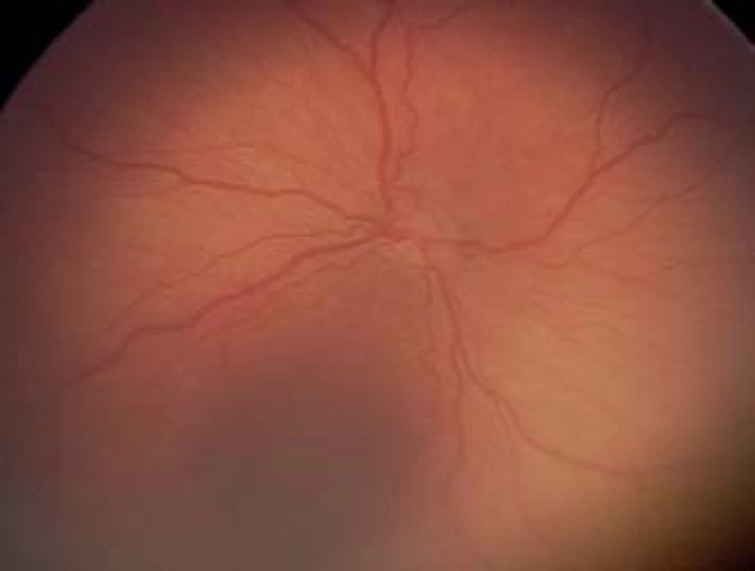 Plus forma ROP – výrazná dilatácia vén a tortuozita arteriol
