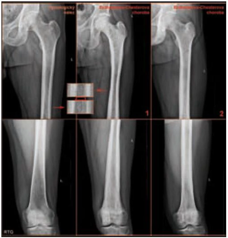 Srovnání normálního nálezu na skiagramu stehenních kostí a nálezu při postižení skeletu Erdheimovou-Chesterovou chorobou.

(1) Symetrické difuzní postižení osteosklerotickým procesem s ušetřením středních diafýz a distálních epifýz femorů. Kortikalis je v proximální a distální diafýze z vnější strany ztluštělá. V detailu je znázorněno zúžení dřeňové dutiny stehenní kosti u nemocného v porovnání s normálním nálezem. Na rozdíl od řady kortikálních apozic (renální osteodystrofie, potraumatické stavy a další), které po přestavbě dřeňovou dutinu zachovávají nebo je zúžení přítomno jen v krátkém úseku, dochází u pacientů s Erdheimovou-Chesterovou chorobou k pozvolnému zužování dřeňové dutiny, aniž by byly kromě zesilování kortikalis patrné jednoznačné změny struktury skeletu.

(2) Oboustranně difuzní zvýšení opacity stehenních kostí zesílením kompakty, která zužuje projasnění nitrodřeňové dutiny.