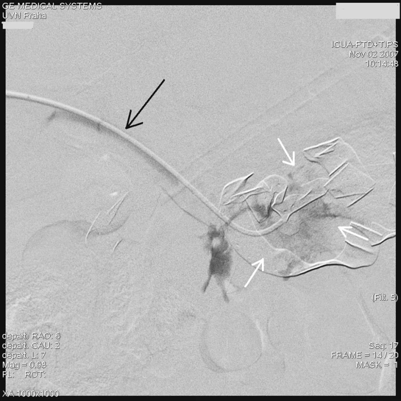 Angiografie transhepatálně zavedeným katétrem (černá šipka) do místa aroze, s dobře patrným únikem kontrastní látky (bílé šipky)
Fig. 2. Angiography with transhepatic introduction of the catheter (black arrow) into the arosion site with marked leakage of the contrast matter (white arrows)