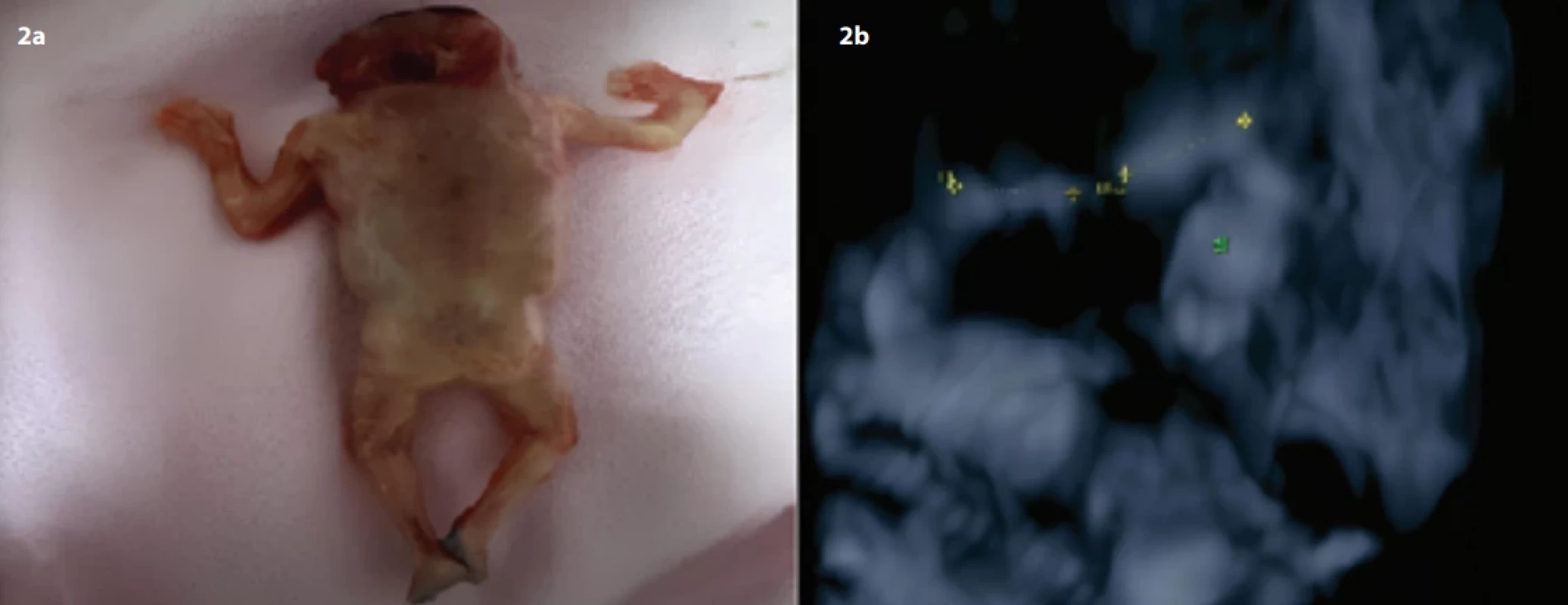 2a. Case 14 – fetal necropsy fi ndings. 2b. Case 14 – 3D skeletal rendering mode radial deviation-radius HL (Humerus) (Hand). Obr. 2a. Případ 14 – nálezy z pitvy plodu. 2b. Případ 14 – 3D skeletální rendering mód radiální odchylky-poloměru HL (pažní kost) El (ruka).