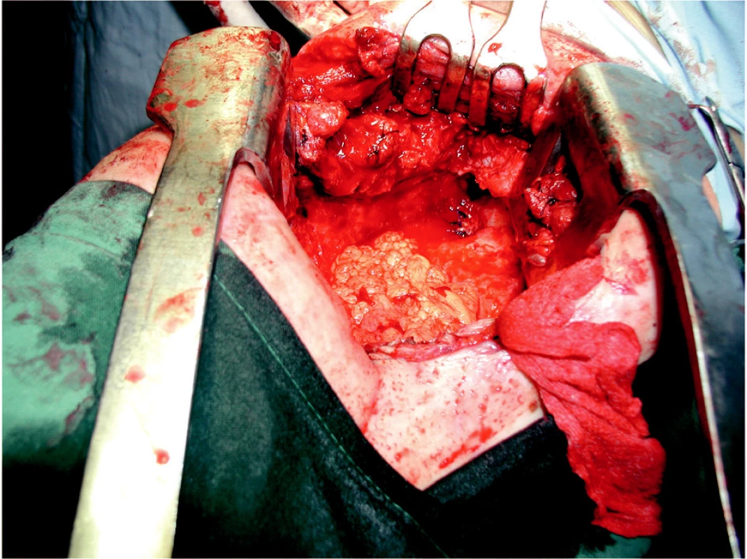 Peroperačný pohľad na miesto sutúry kýpťa bronchu
Fig. 2. A peroperative view of the bronchial fistula suture
