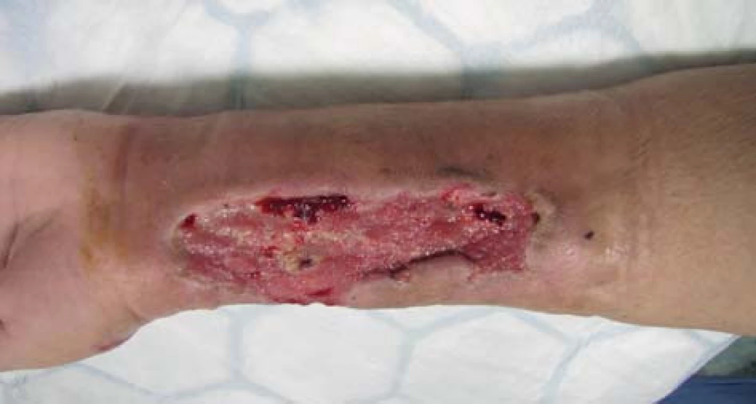 Hojící se rána
Fig. 3: Wound healing