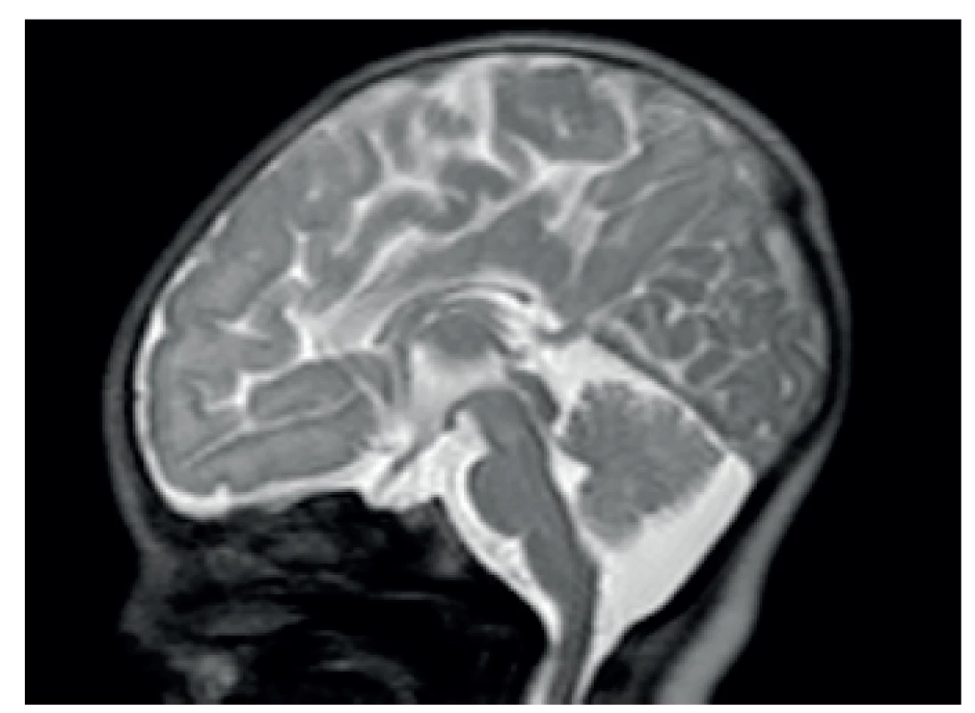 MR dysgeneze kalózního tělesa.
Fig. 2. Magnetic resonance imaging – corpus callosum dysgenesis.