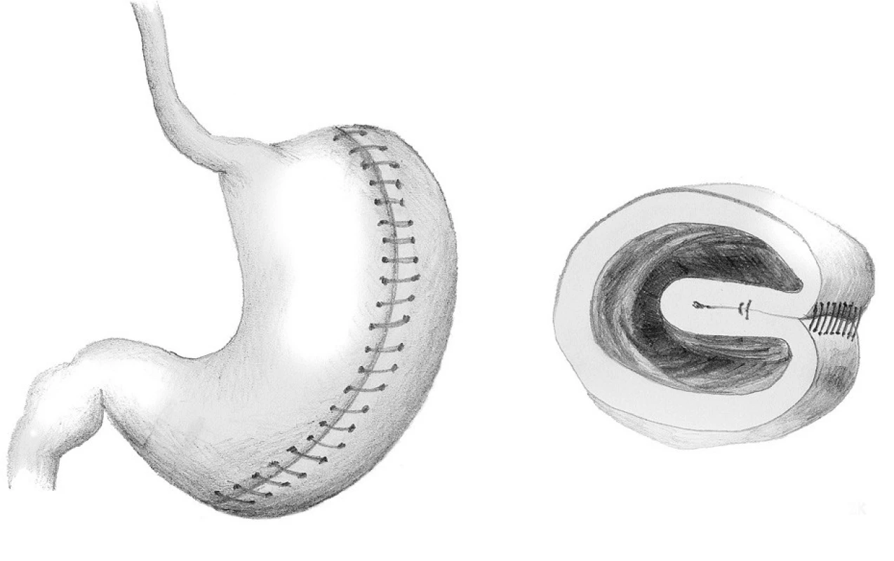 Vertikální gastrická plikace
Fig. 2: Vertical greater curvature gastric plication
