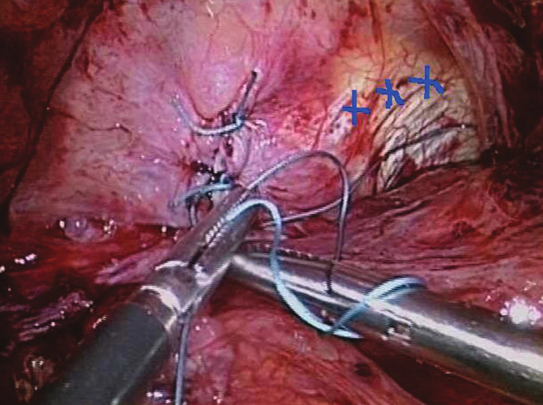 Přední hiátorafie a fundofrenopexe(modré křížky)
Fig. 17: Anterior hiatoraphy and fundophrenopexy (blue crosses)