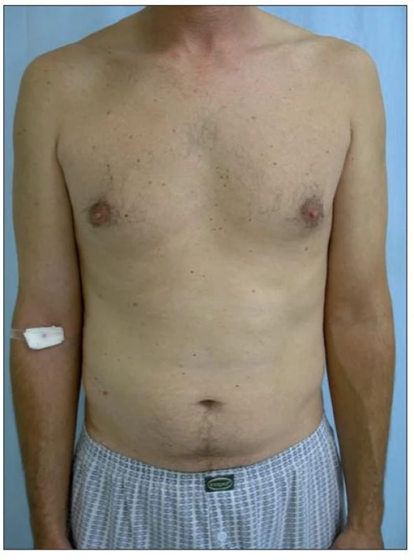 Remise onemocnění, stav po 16 měsících léčby Enbrelem v dávce 25 mg s. c. 1krát týdně