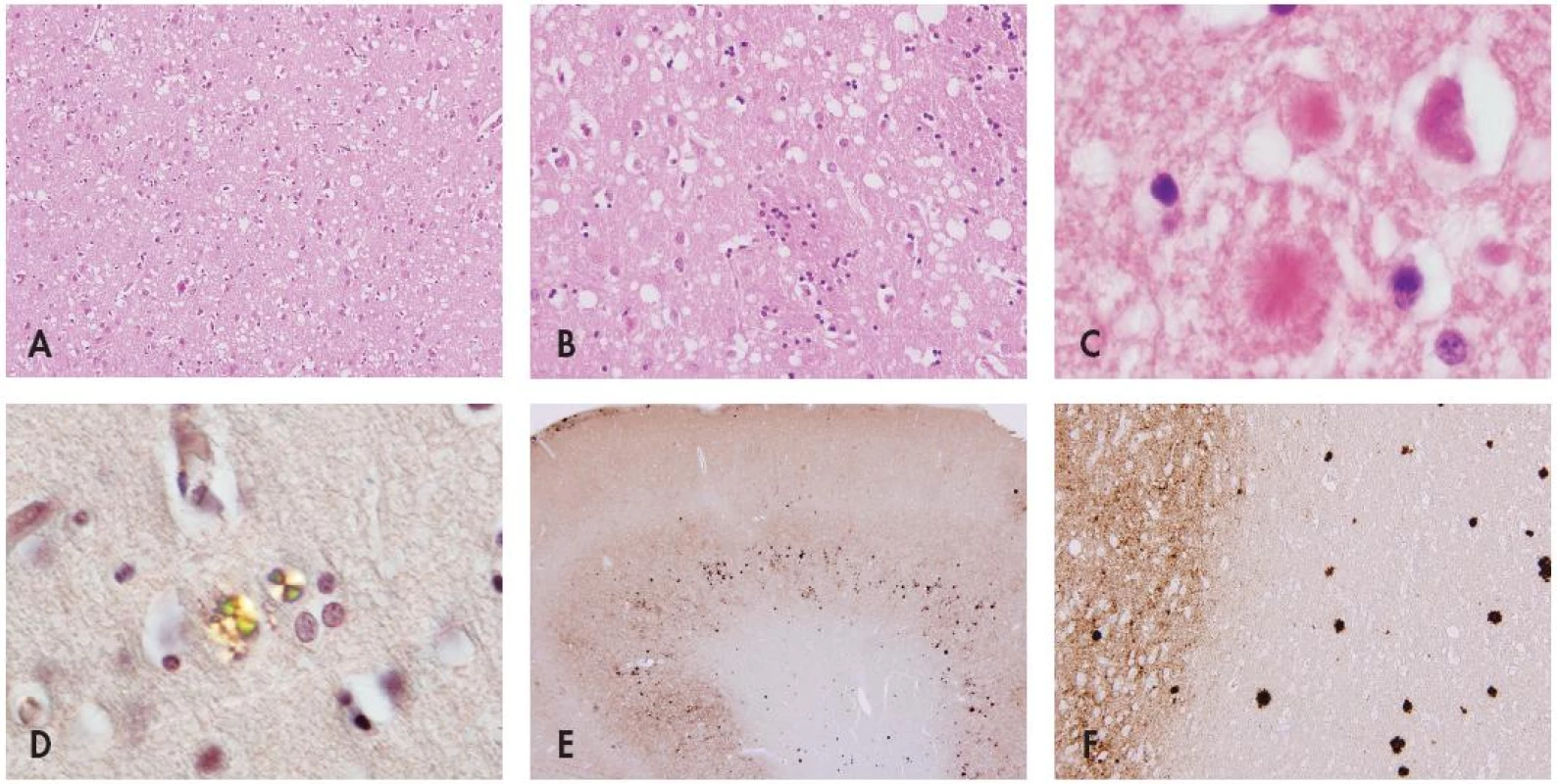 Mikromorfologie prionových onemocnění. Spongiformní dystrofie ve standardním barvení HaE (A) ve frontálním kortexu (původní zvětšení 200x) a (B) ve striatu (původní zvětšení 400x) s (C) přítomností plak „kuru-like“ typu (původní zvětšení 400x). (D) Charakteristické vlastnosti amyloidu v polarizovaném světle v histochemickém barvení konžskou červení v „kuru-like“ plakách (původní zvětšení 400x). Imunohistochemická pozitivita (E) difusní synaptická ve frontálním kortexu (původní zvětšení 200x) a (F) amyloidových plak prinového proteinu v okcipitálním kortexu a subkortikální bílé hmotě (původní zvětšení 400x) depozit patologické formy prionového proteinu pozitivní v reakci s monoklonální protilátkou proti PrP.