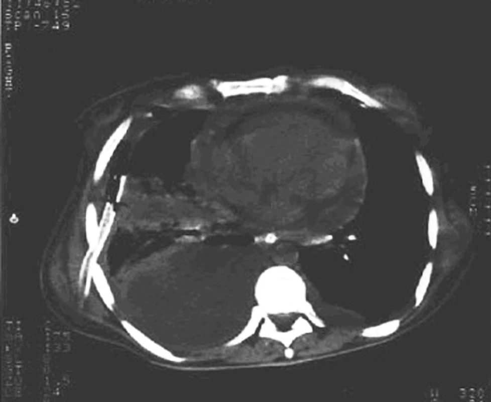 CT snímek hrudníku s drénovaným výpotkem a empyémovou dutinou cíleně
Fig. 2. A CT scan of a thorax with drained exudate and empyema cavity