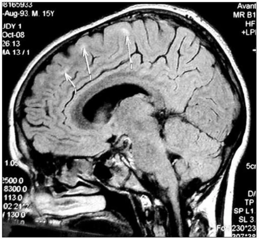 Sagitální řez CNS: MR FLAIR, šipky ukazují ložiska zvýšené intenzity signálu v subkortikální oblasti.
Fig. 1. Sagittal section of CNS: MR FLAIR, arrows show the foci of increased signal intensity in subcortical area.