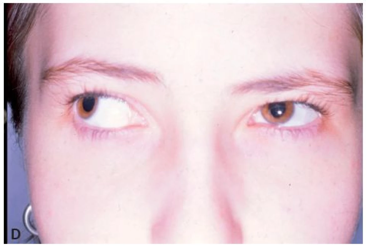 Dvacetiletá pacientka s iniciální formou strabismus sursoabduktorius – A,B: předoperační postavení a dextroverze bulbů a C,D: pooperační postavení a dextroverze bulbů