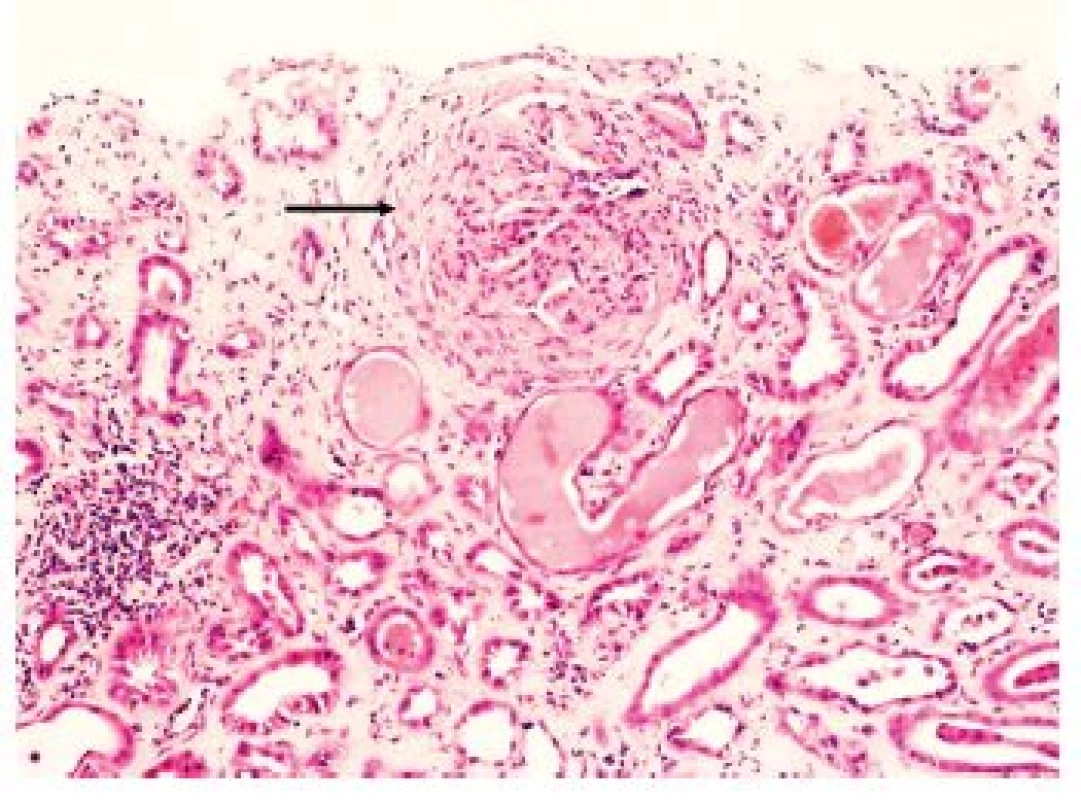 Granulomatóza s polyangiitidou. Glomerulus s okluzivním fibrocelulárním srpkem (šipka). V intersticiu fibróza, v některých tubulech deskvamované epitelie a stagnace eozinofilního obsahu. Imunofluorescene typicky negativní. HE, zvětšení 100x.
